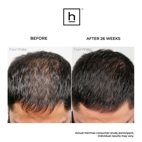 hairtech hair grower|HairMax Laser Hair Growth Devices to Reverse Thinning Hair